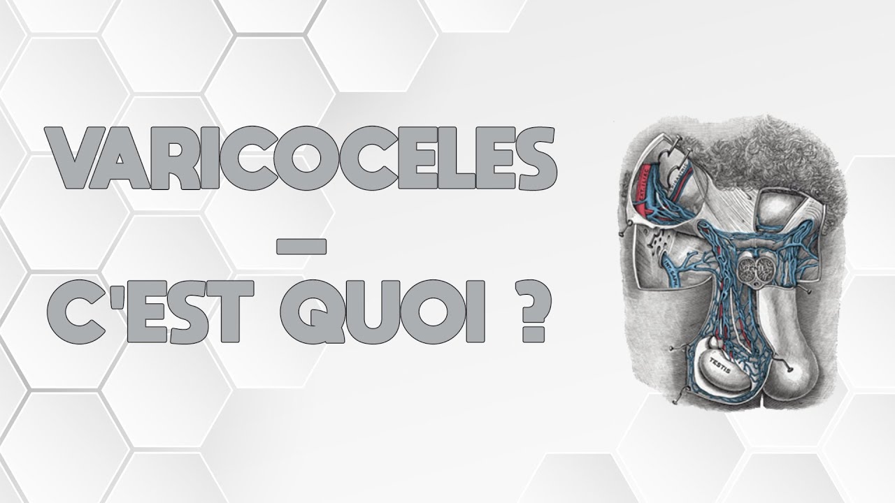 VARICOCÈLE - C'EST QUOI ?
