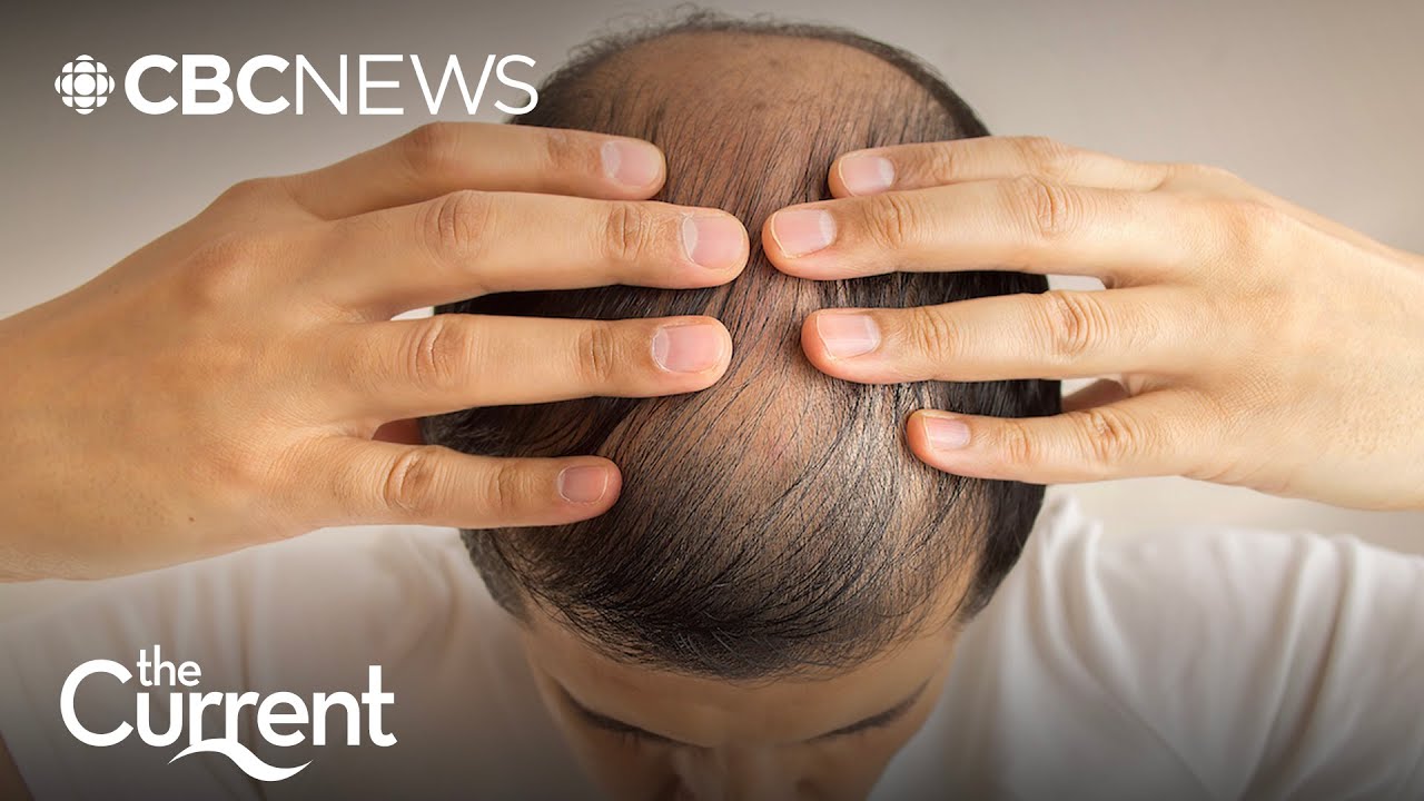 Popular hair loss drug finasteride can have life-altering side effects | The Current