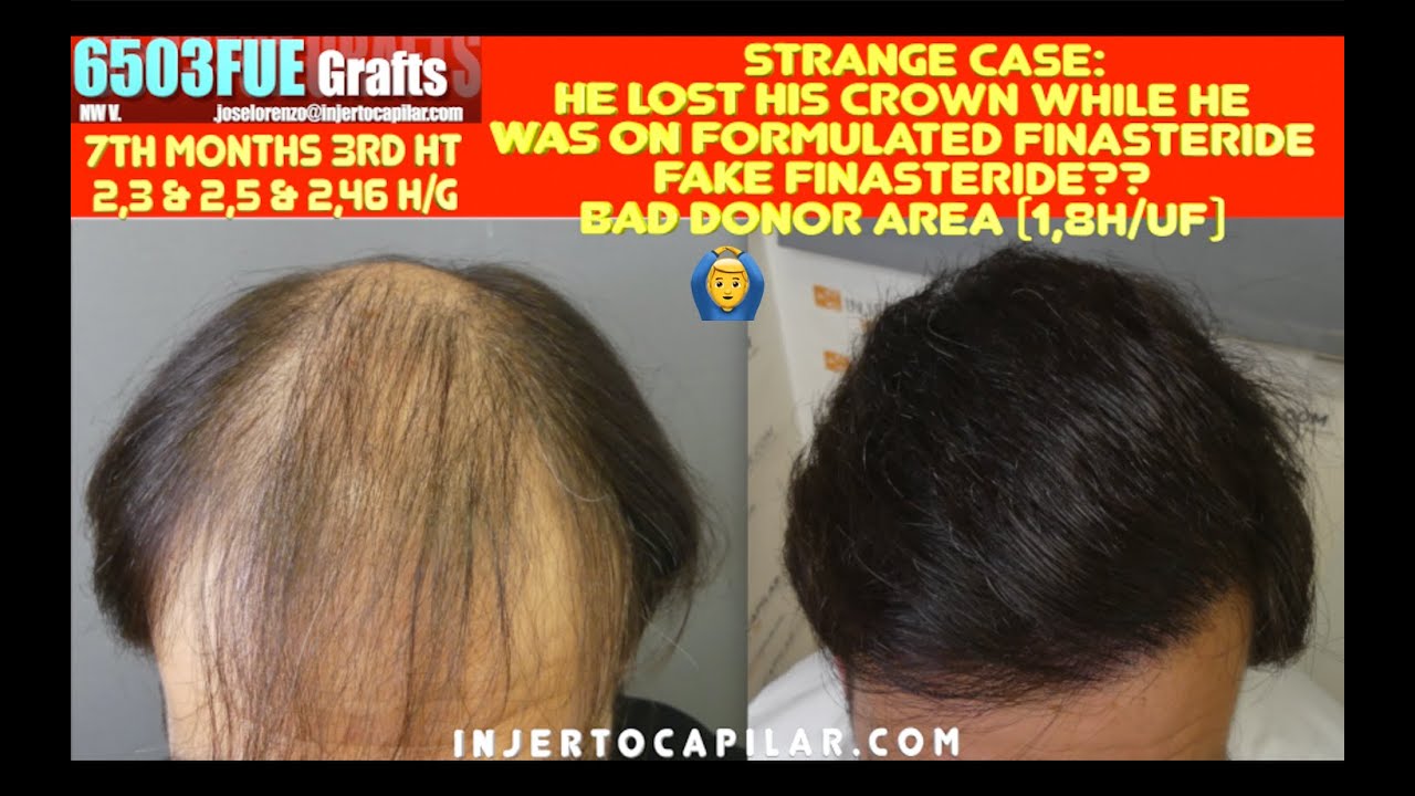 6503FUE Grafts. NW III to NW V in 6mths. FAKE formulated finasteride?. 7 mths 3rd HT. 2837/2022