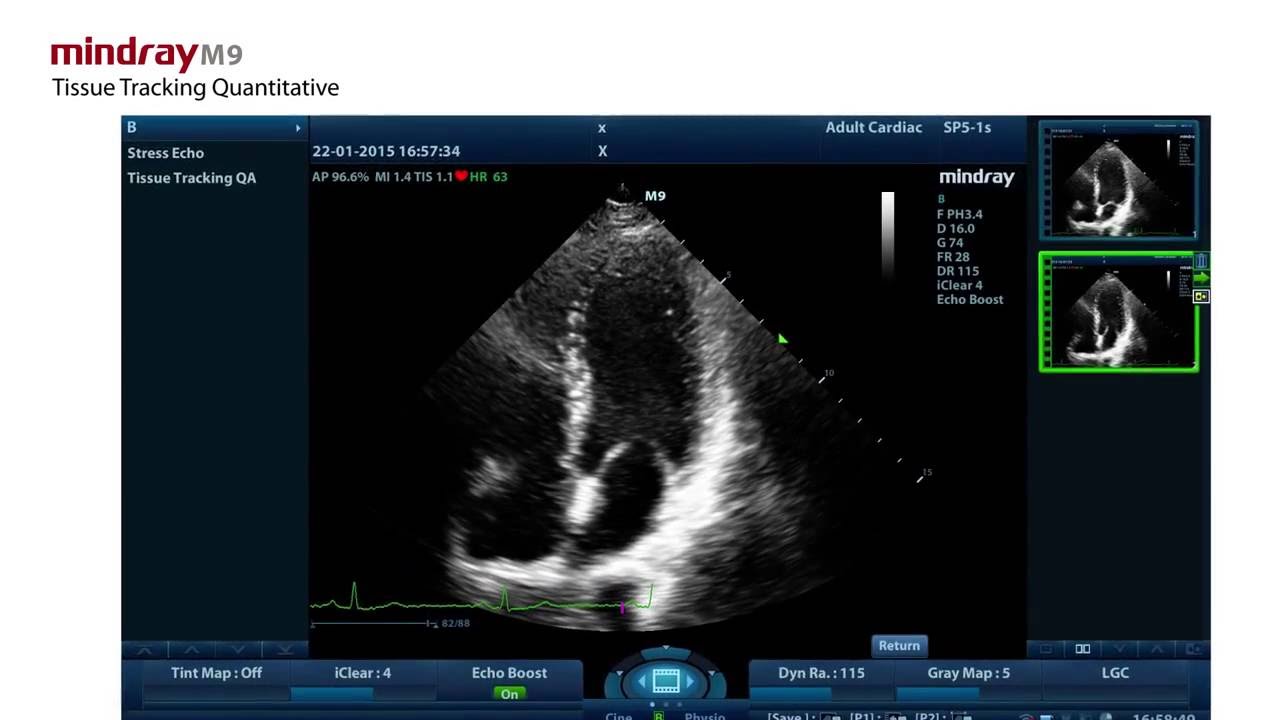 Tissue Tracking Cuantitativo en Mindray M9