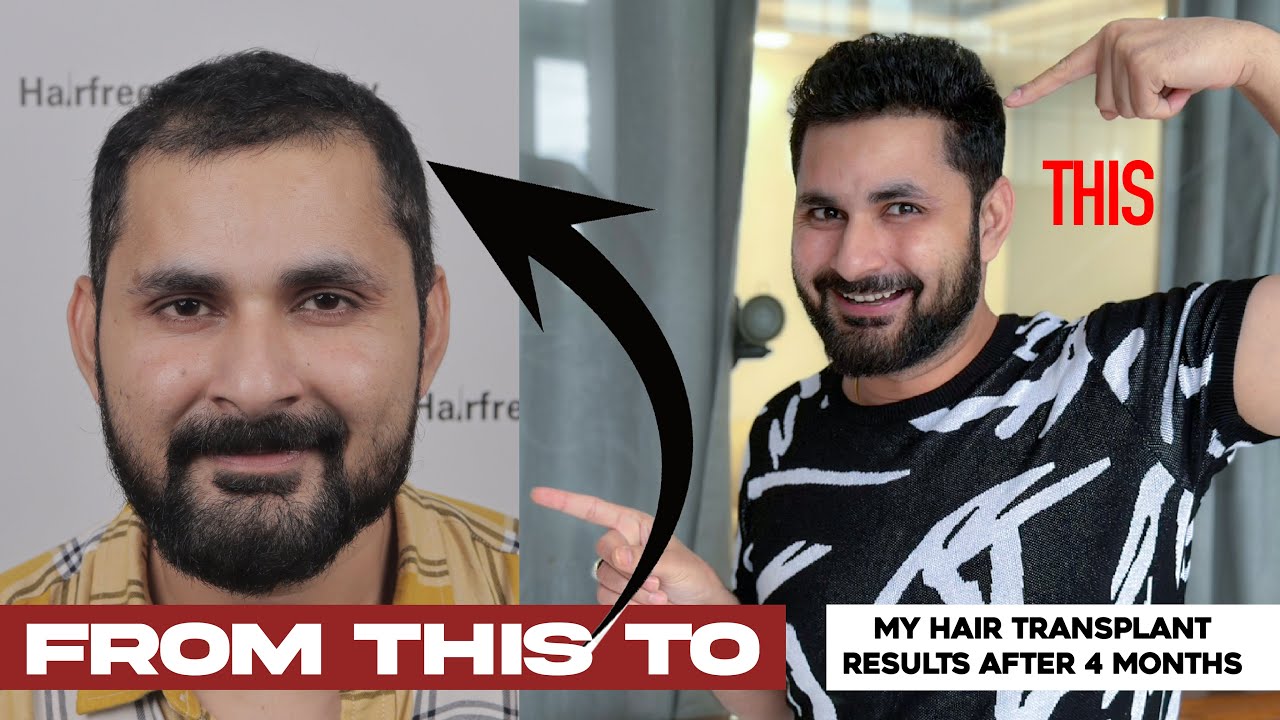 My Hair Transplant Experience after 4 Months | Revealing all secrets of my hair growth | Vlog