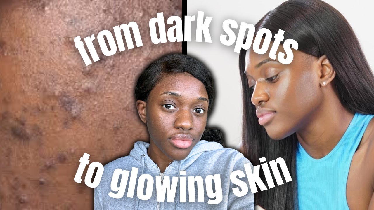 how to ACTUALLY fade stubborn dark spots