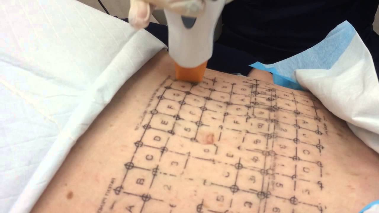Thermage Treatment of the Abdomen - Dr. Michael Kaminer