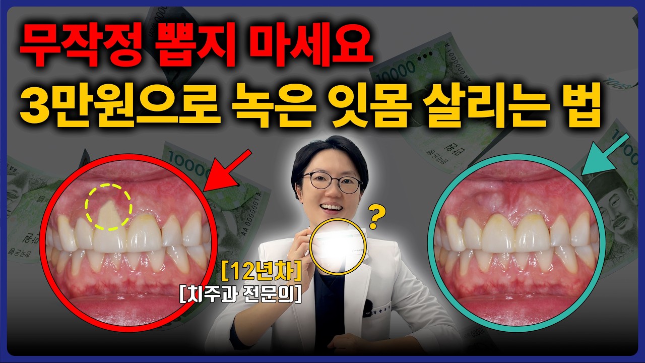 왜 '3만원'짜리 치아 재생술은 점점 사라질까요? (임플란트 하기 전 필수 시청)
