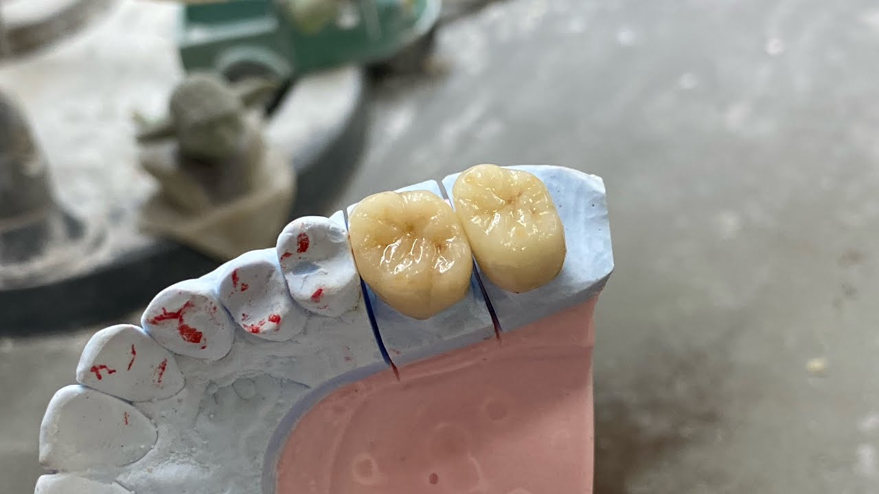 【e.maxの単冠2本ステイン法で】やって行きます！シューベルトの「未完成」は完成品か？#未完成#dentaltechnician #歯科技工士 #デッサン#e.max