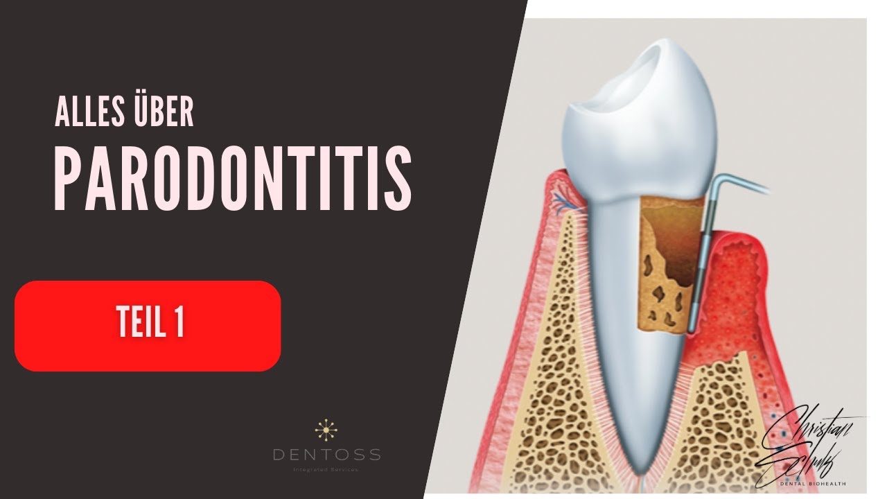 Parodontitis - alles was du wissen solltest! Teil 1