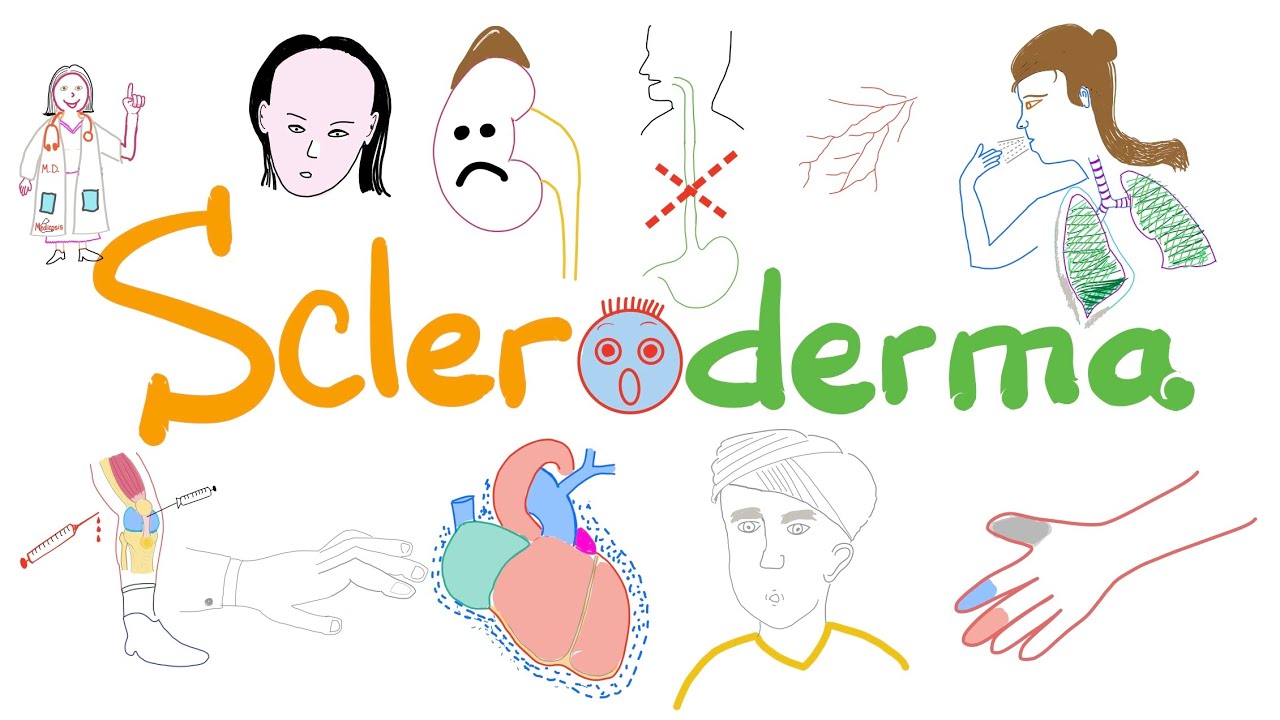 Scleroderma (Systemic Sclerosis) - Signs, Symptoms, Pathophysiology - Rheumatology