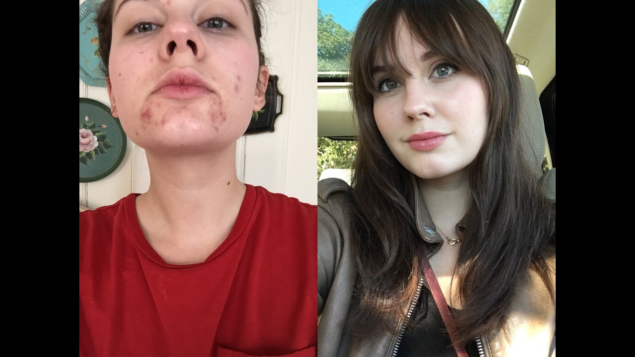 My Acne Story & Current Skincare Routine