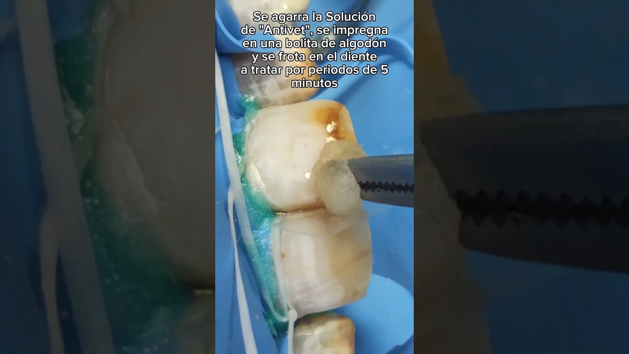 Desmanchador de Dientes con Fluorosis #dientesblancos #desmanchador #fluorosis #antivet #dentist