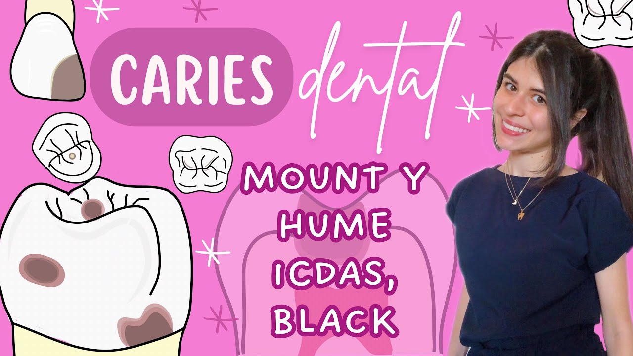 CARIES DENTAL (MOUNT Y HUME, ICDAS Y BLACK) | Fátima Luna