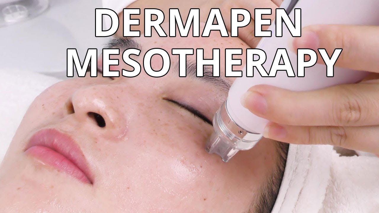 Dermapen Mesotherapy | How Microneedling Treatment  Is Done | NV6130 MYCHWAY VIDEO