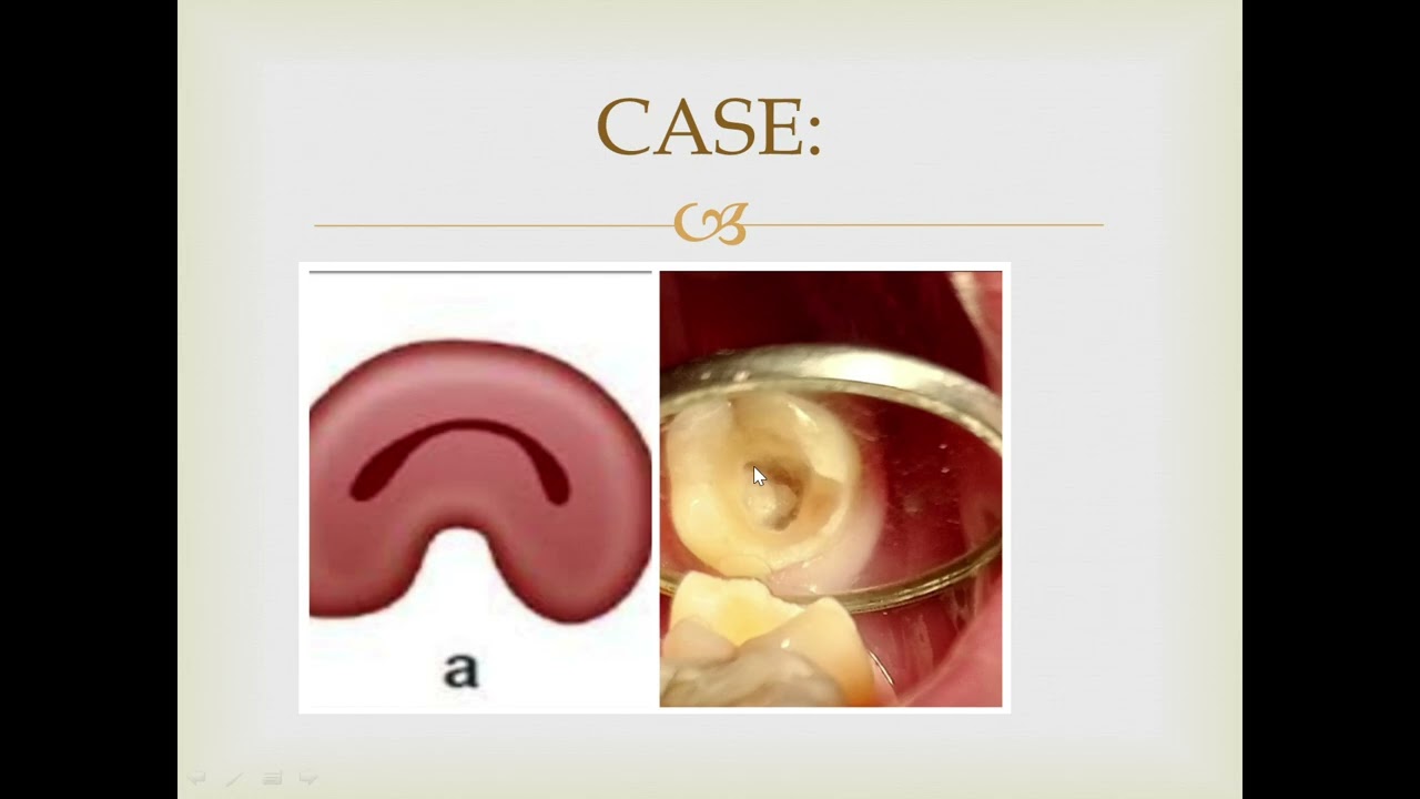 MANAGEMENT OF C-SHAPED CANAL