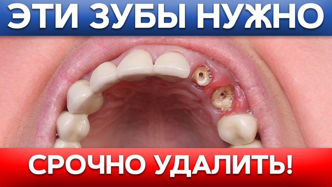 Проще удалить, чем ЛЕЧИТЬ! ТОП-4 случая, когда зуб НЕ СПАСТИ!