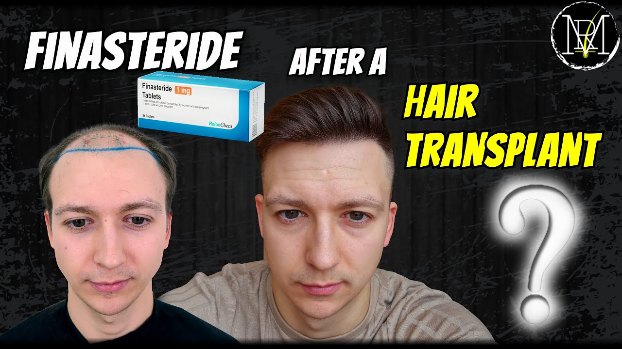 Finasteride After Transplant – Worth It?