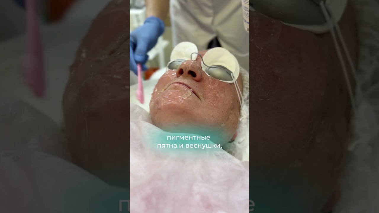 ⚡LUMENIS М22 (IPL)⚡
