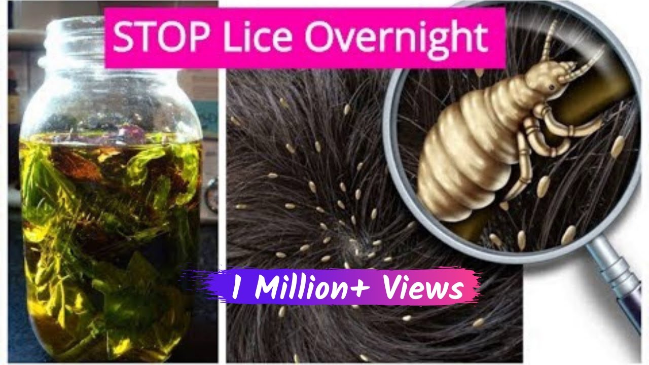 पाएं जूं और लीखों से जीवन भर के लिए छुटकारा| Homemade OIL for Lice & Nits removal|Sushmita's Diaries