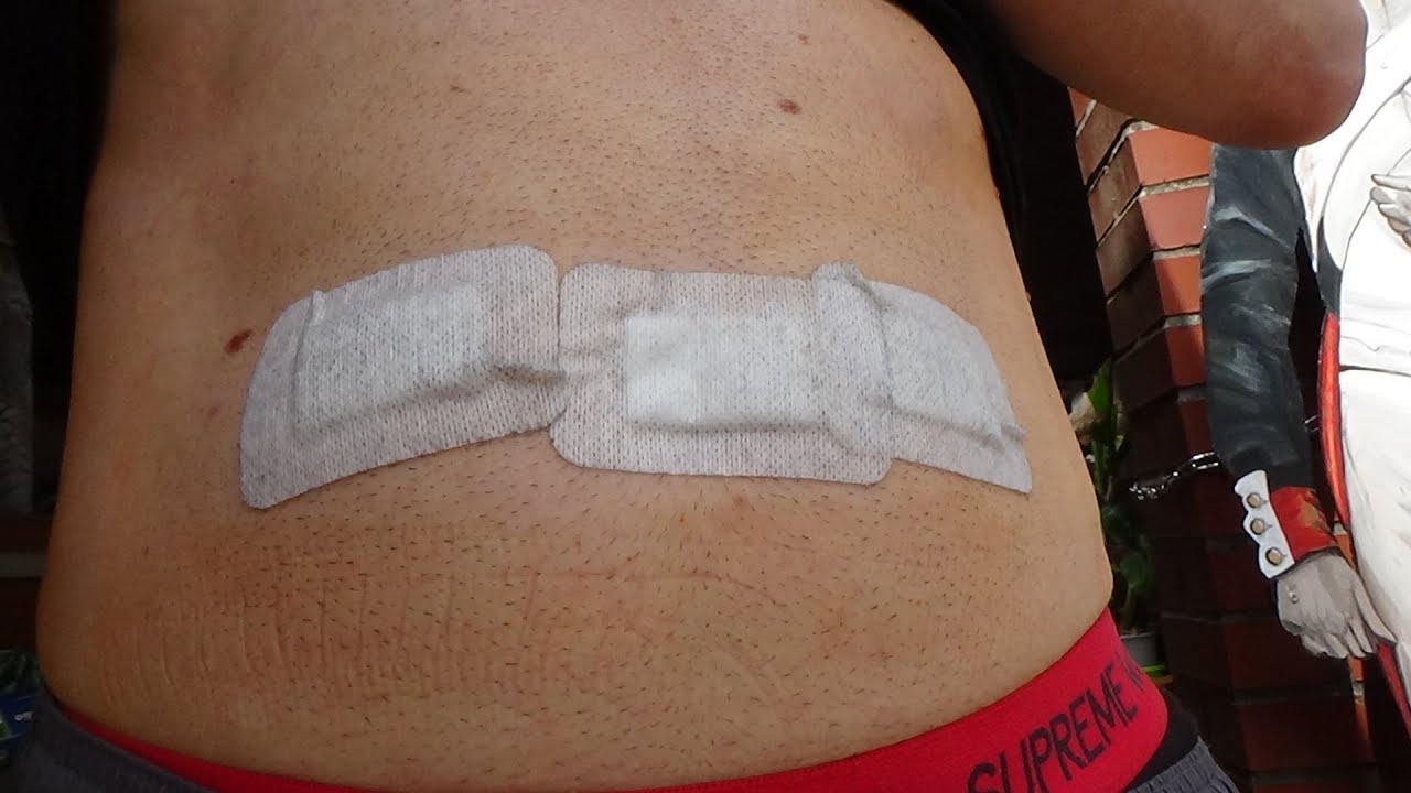 Leistenbruch OP Erlebnißbericht