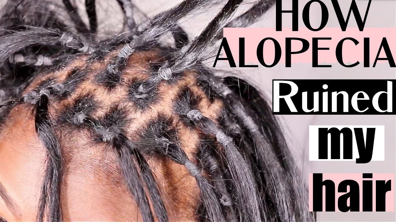 How Alopecia RUINED my hair BEFORE it fell out. Will I wear my head BALD?