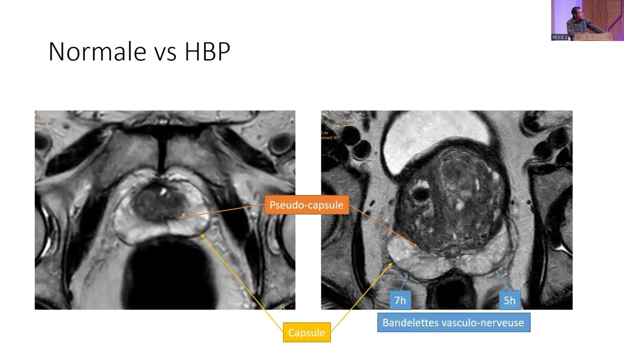 IRM et cancer de la prostate : que doit savoir l'urologue