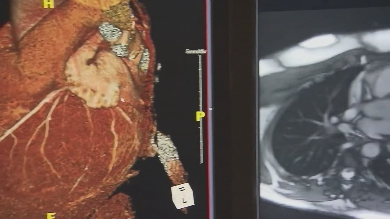Expert: Very few people die from myocarditis