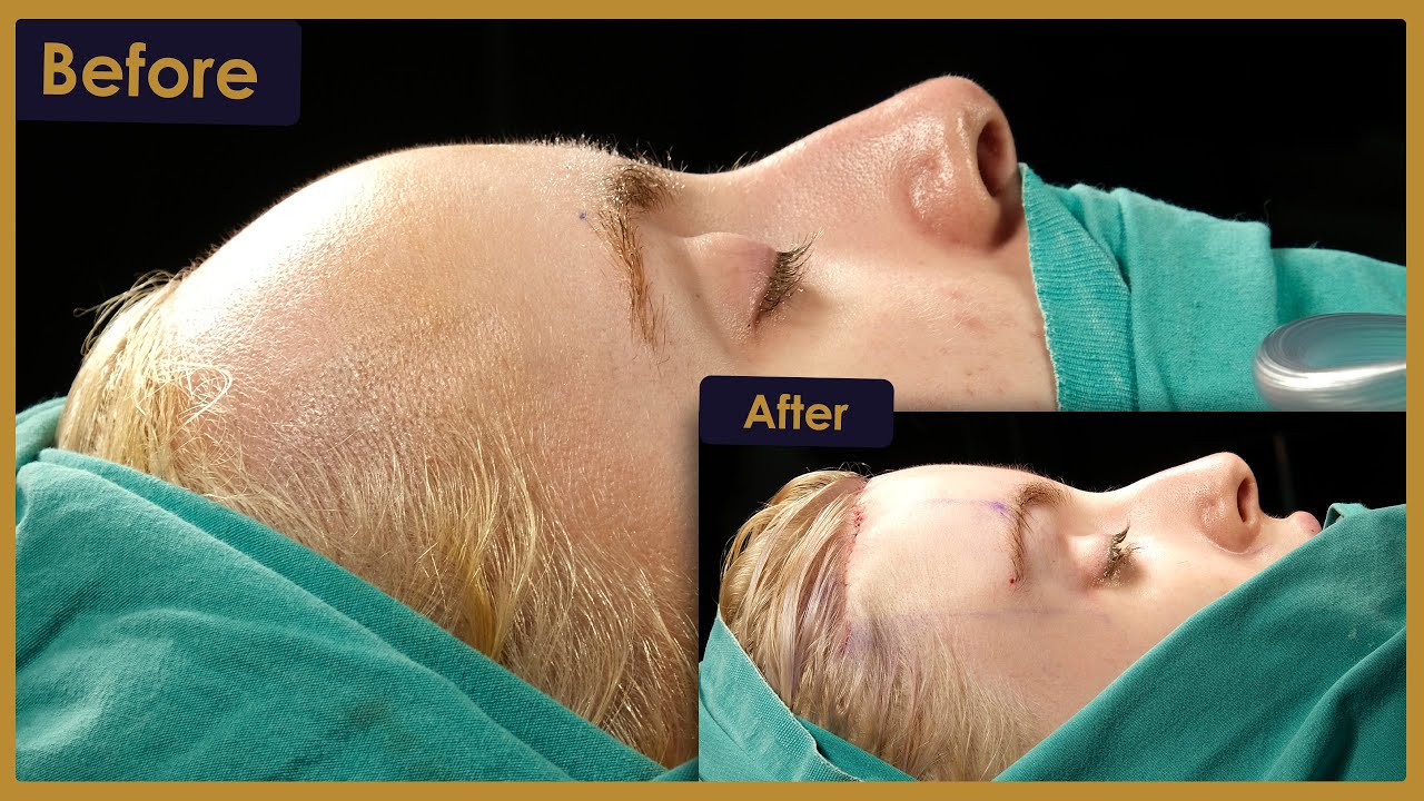 Ella's Forehead Reduction Surgery Journey in Turkey! | Estherian Clinic
