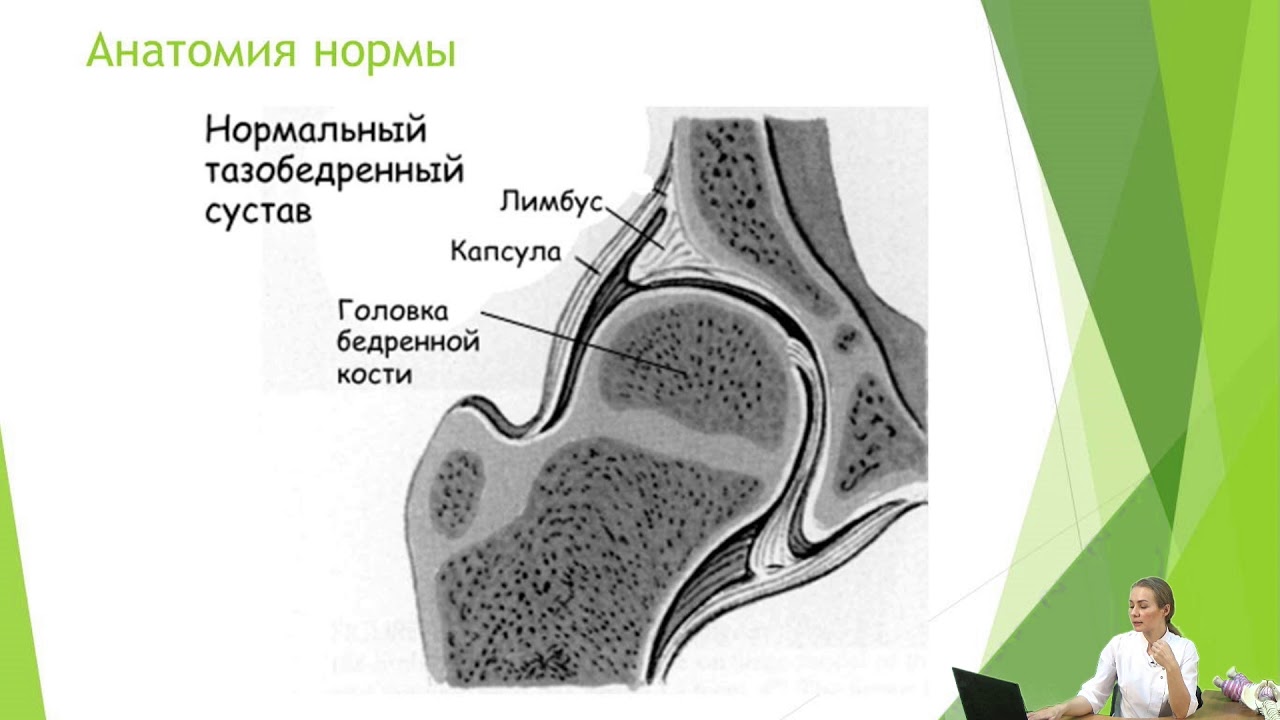 Дисплазия тазобедренных суставов.
