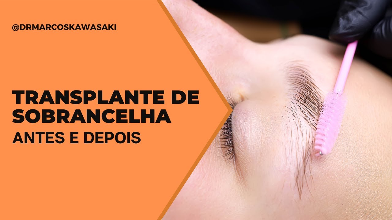 Transplante de sobrancelha: antes e depois