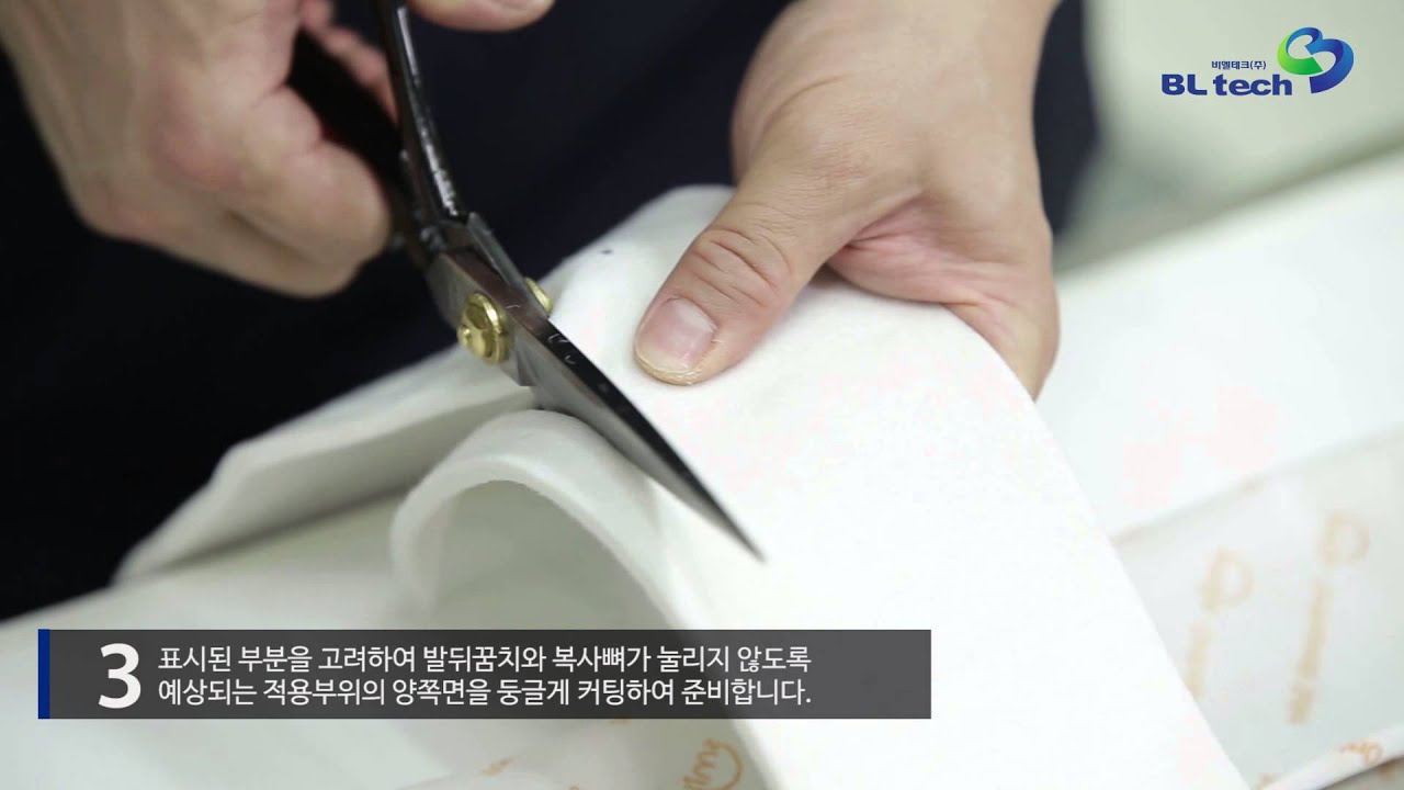 reinforced posterior leg splint 시술