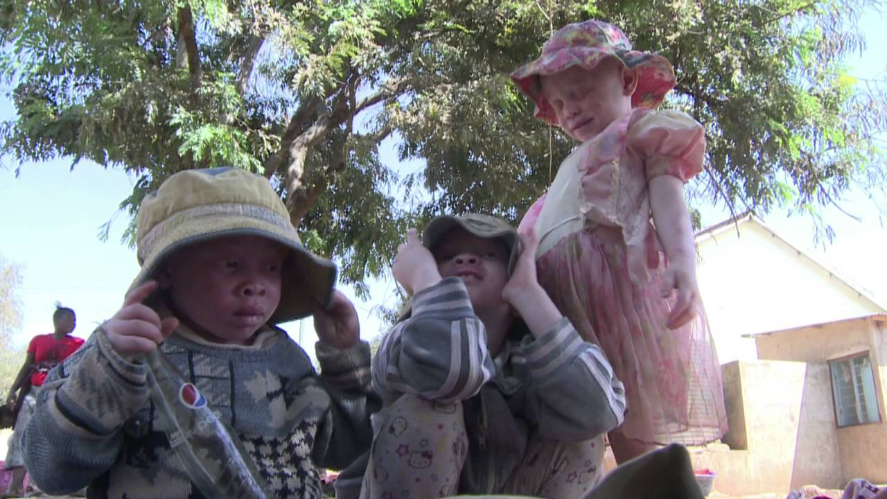 Protect the rights of people with albinism