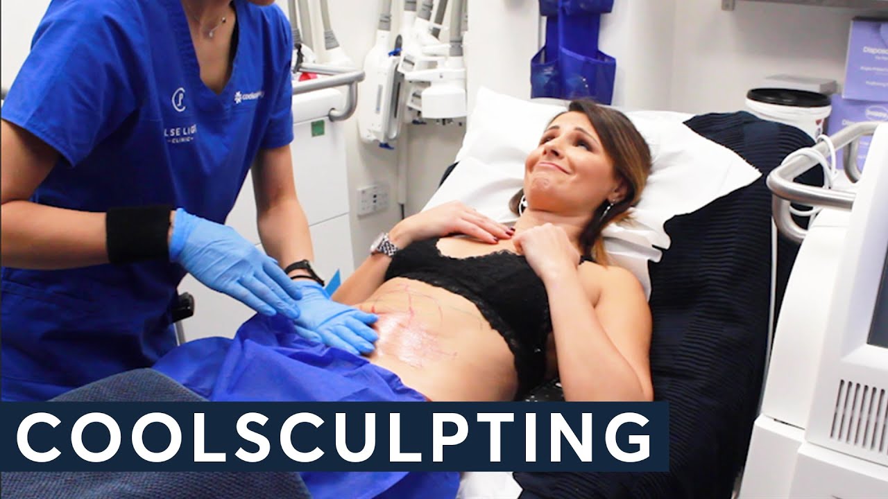 Fat Freezing Review -  8 Months after CoolSculpting - Was it worth it?