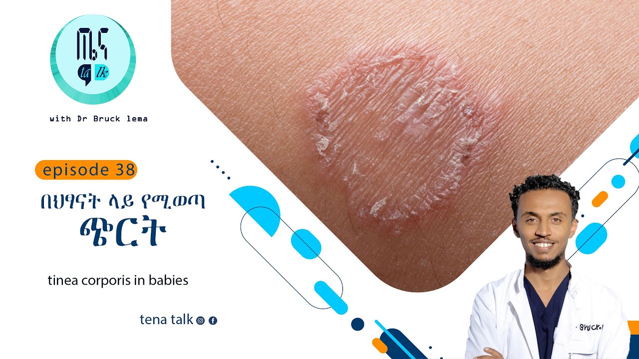 በህፃናት ላይ የሚወጣ ጭርት ring worm (tinea corporis )in babies