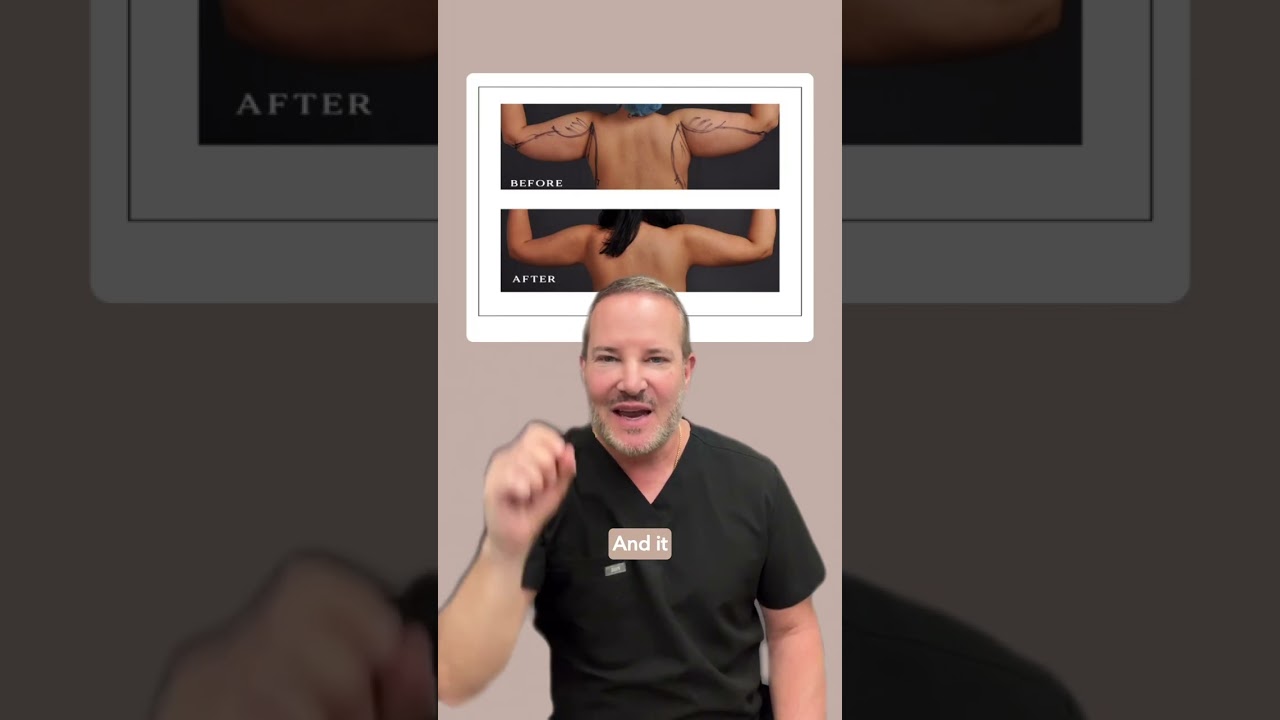 Arm Liposuction - Gentle Sculpt
