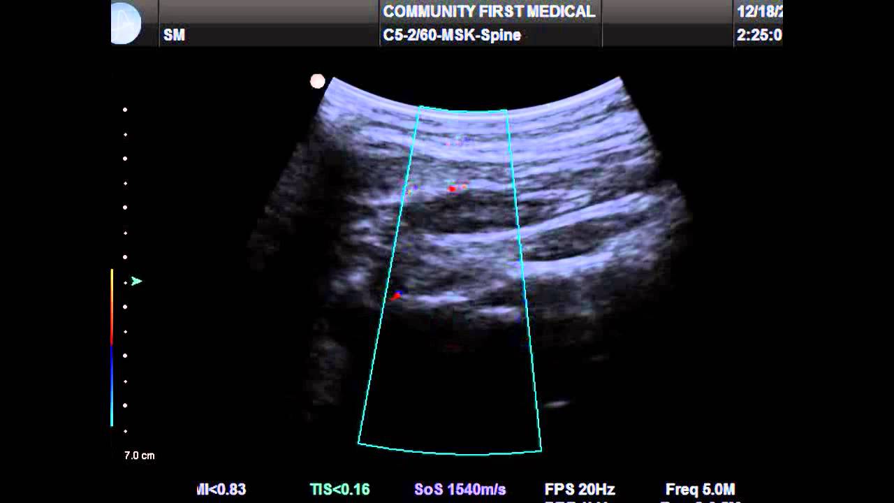 Ultrasound Guided Occipital Nerve Block