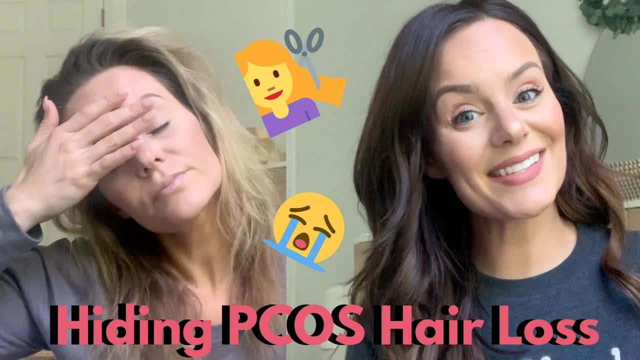 My Emotional And Personal Experience with Advanced PCOS Hair Loss | Lauren Stewart
