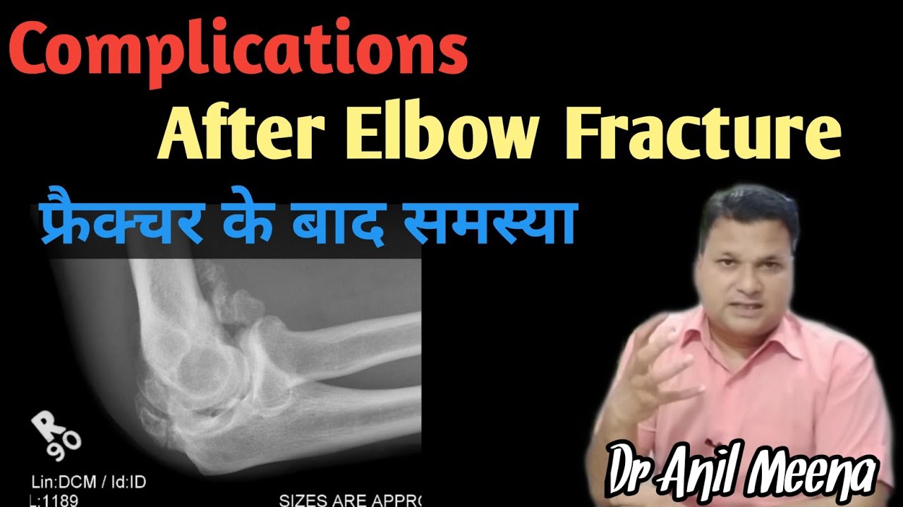 Complications after elbow surgery |   elbow Fracture Problem | Myoscitis Ossification  | in Hindi