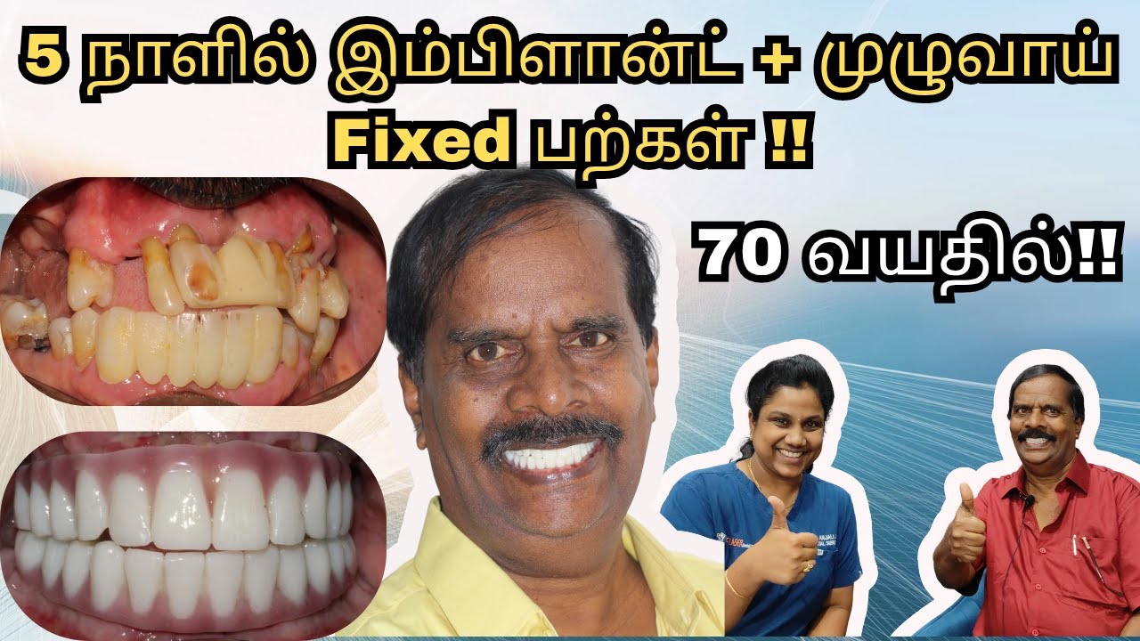 All on 5 இம்பிளான்ட் + முழுவாய் Fixed பற்கள் சிகிச்சை செலவு ! Cost of full teeth implants chennai !