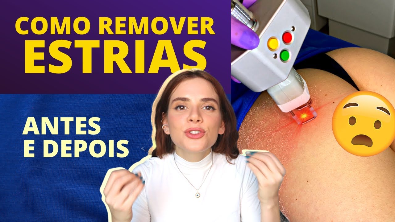 TRATAR ESTRIAS VALEU A PENA? ANTES E DEPOIS