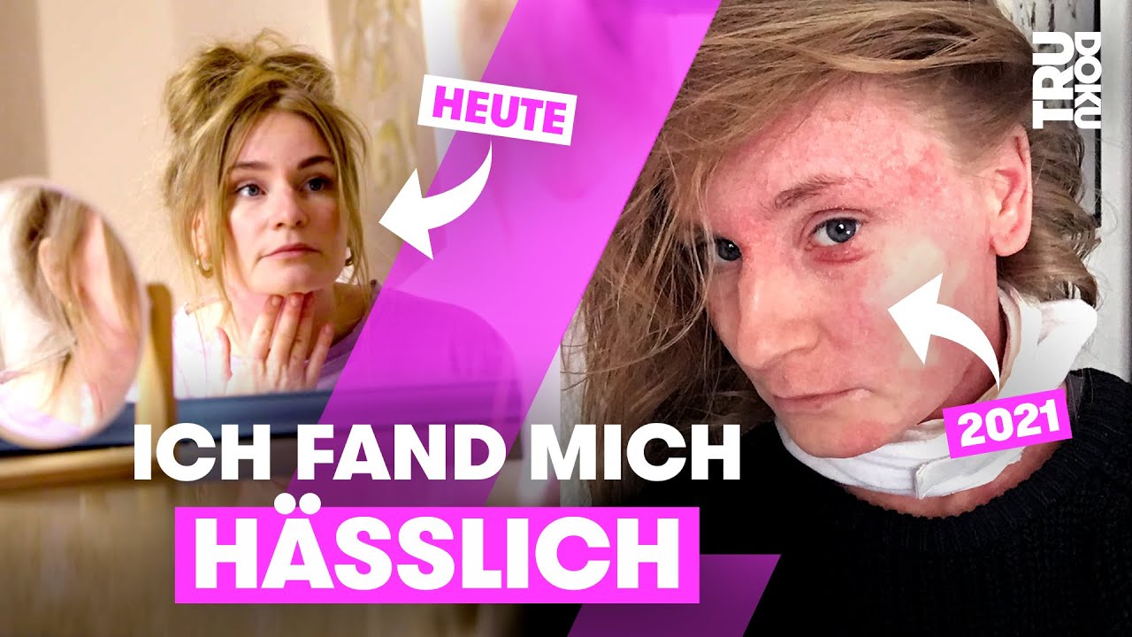 Extreme Neurodermitis: “Ich wollte niemandem mehr begegnen” I TRU DOKU