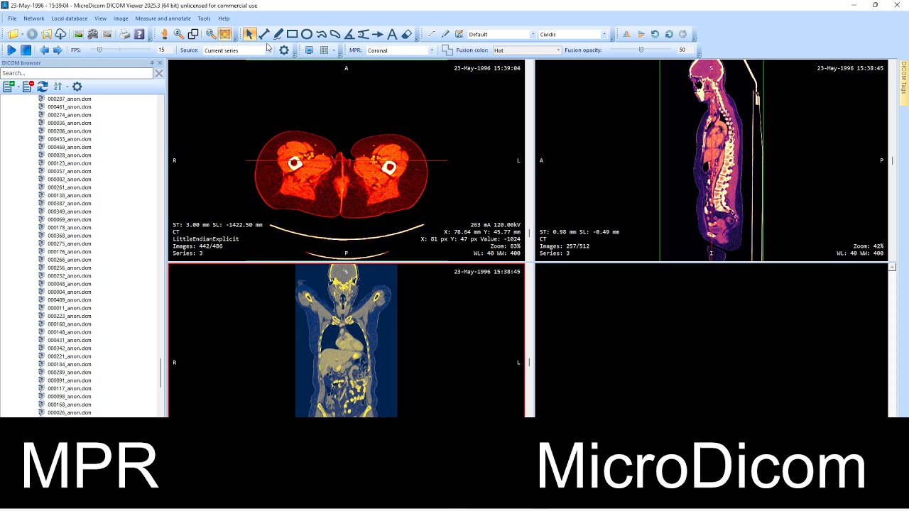 Multiplanar Reconstruction (MPR) in MicroDicom