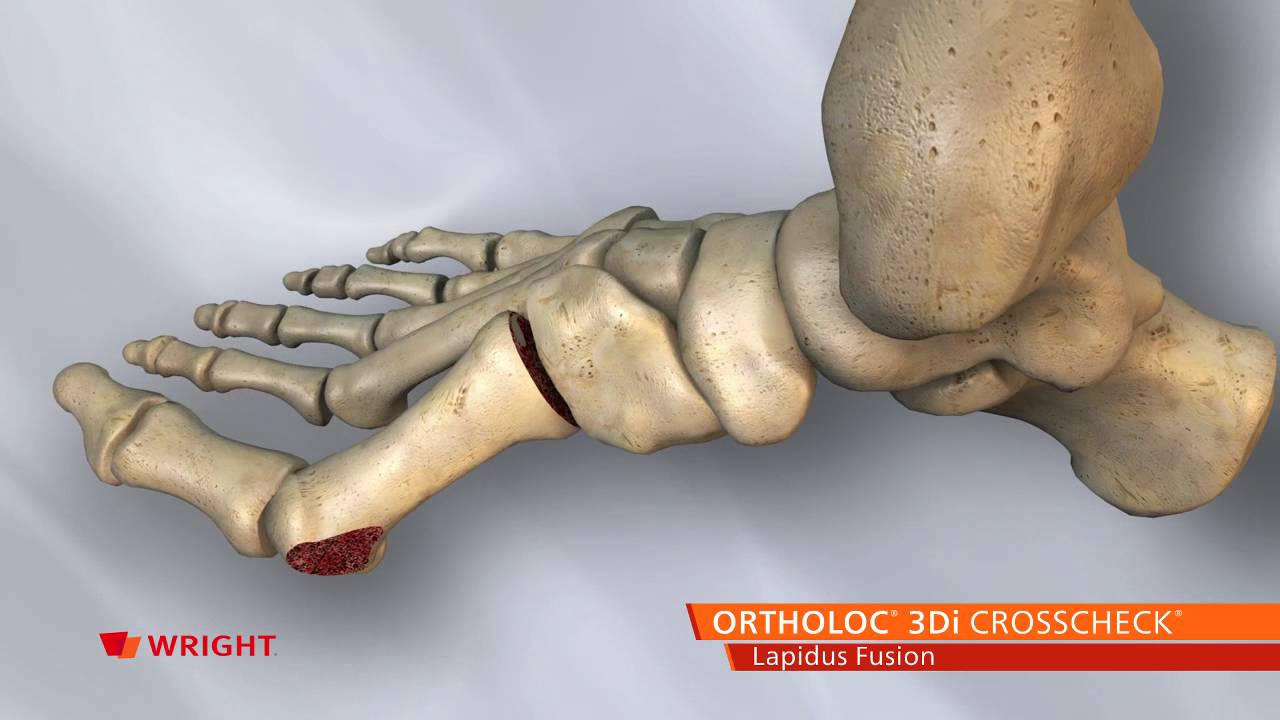 ORTHOLOC™ 3Di CROSSCHECK™ Lapidus Fusion Animation