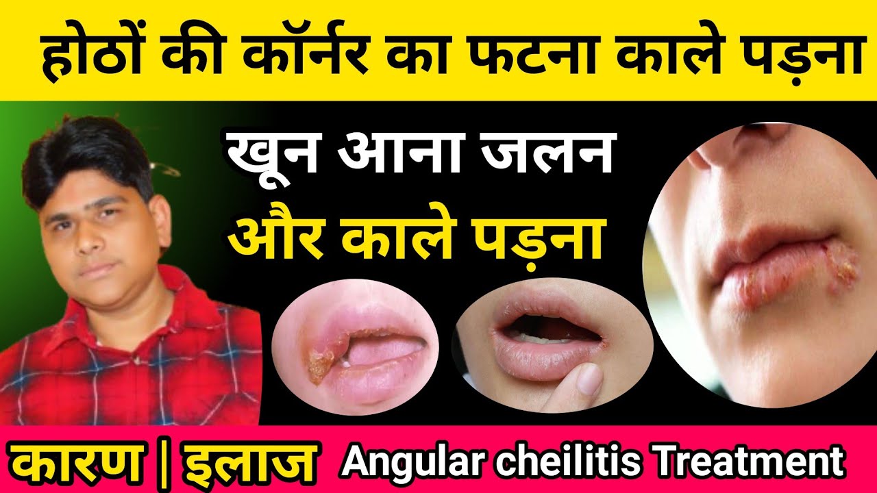 Lips cracking home remedy | Angular cheilitis treatment | Cold sores on lips treatment in hindi