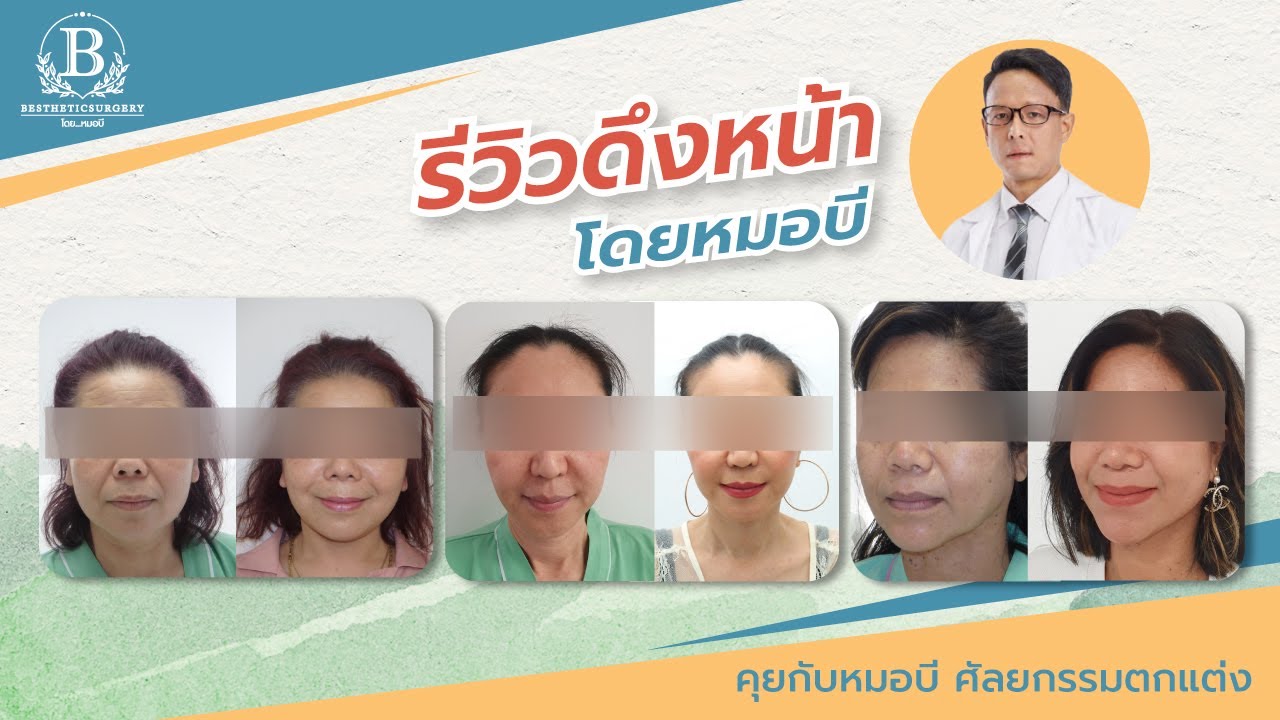 รีวิวดึงหน้า โดยหมอบี