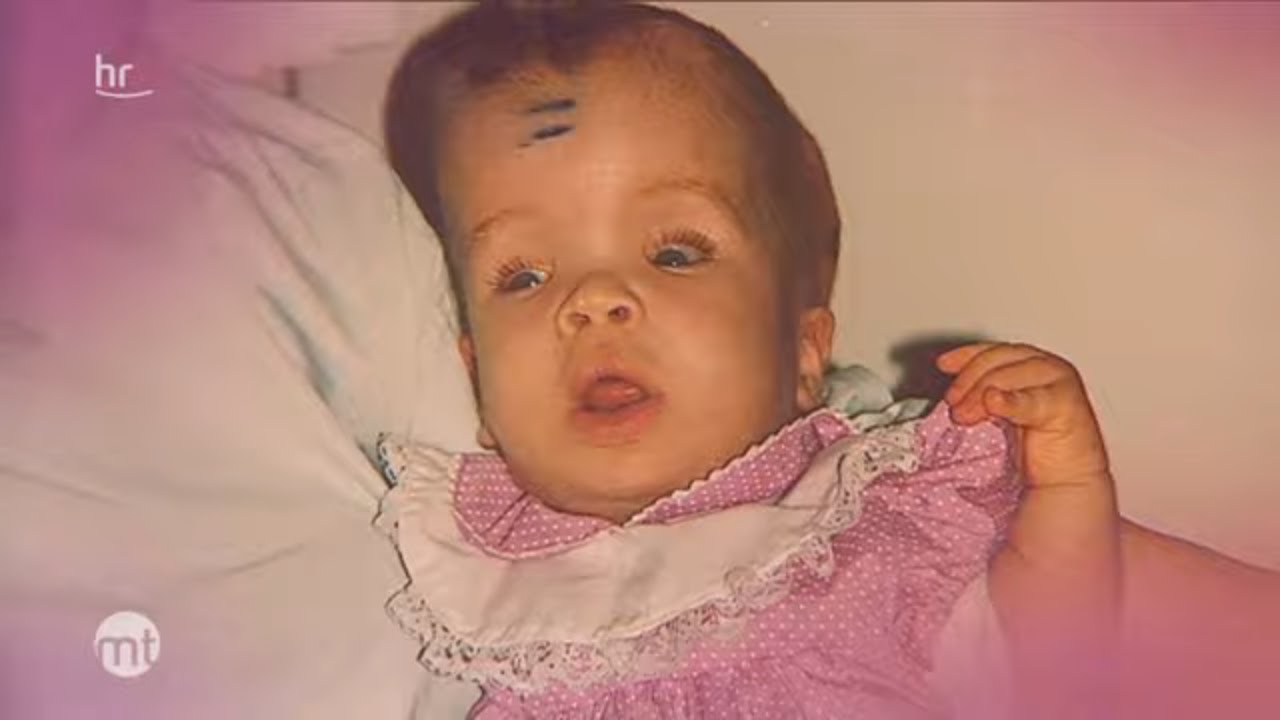 Schinzel-Giedion-Syndrom - 