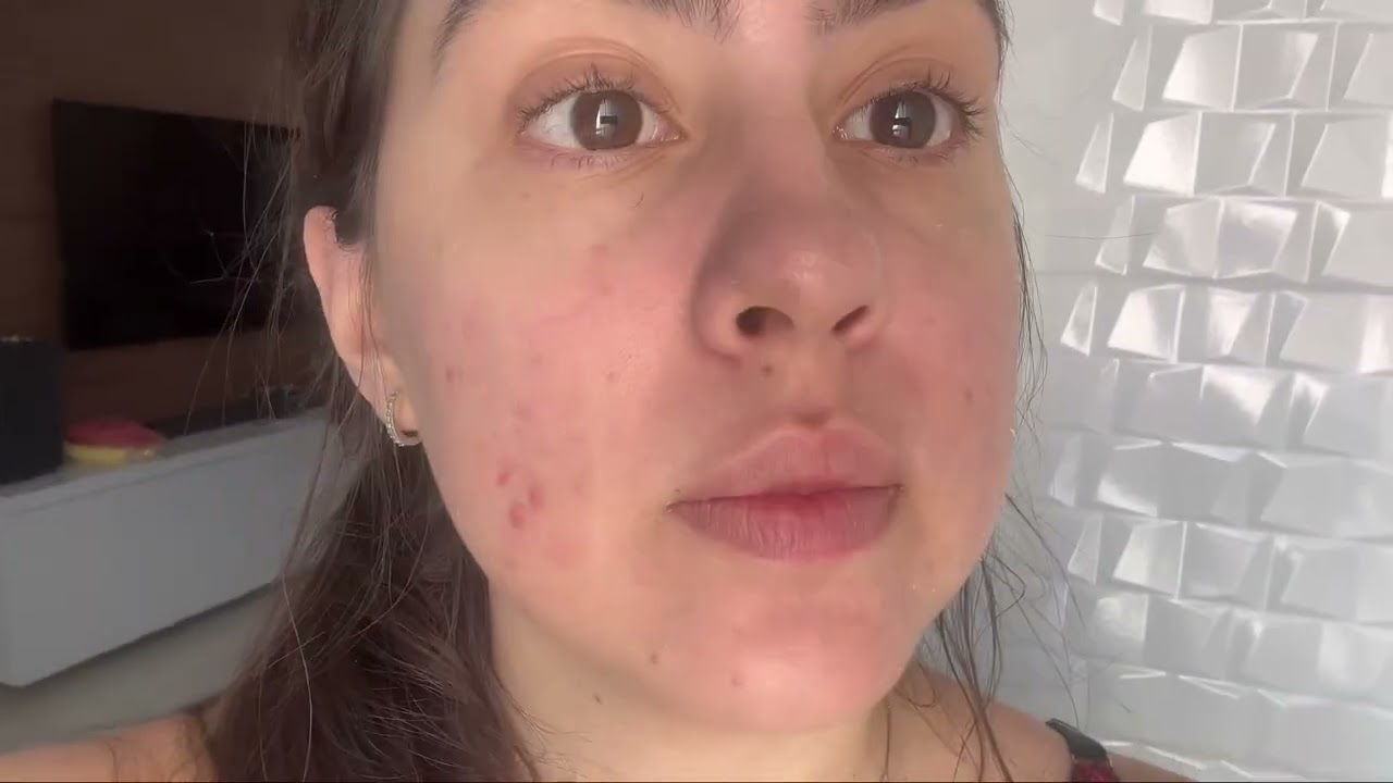 Minha experiência com Laser CO2 fracionado para cicatrizes de acne