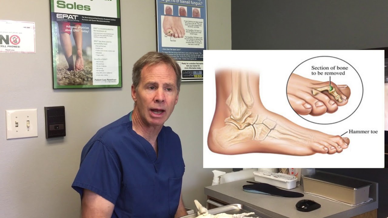 Capsulitis (Inflammation of Second Metatarsal) -- Information, Treatment Options