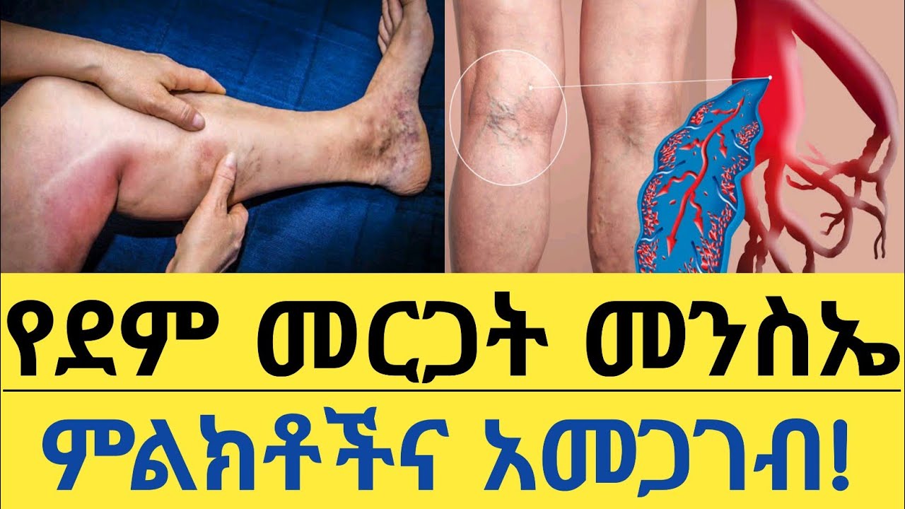 የደም መርጋት በሽታ መንስኤዎች ፣ ምልክቶች እና መከላከያ መፍትሄዎች| Blood clots causes, symptoms and prevention