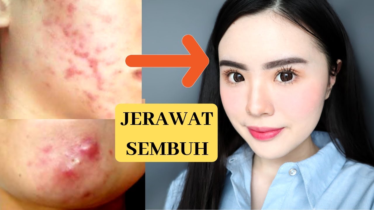 7 MAKANAN YANG HARUS DIHINDARI UNTUK MENGHILANGKAN JERAWAT (PENGALAMANKU)