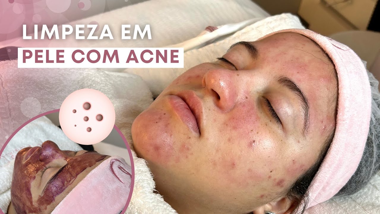 Limpeza de Pele Profissional em Pele Acneica - Produtos Tulípia