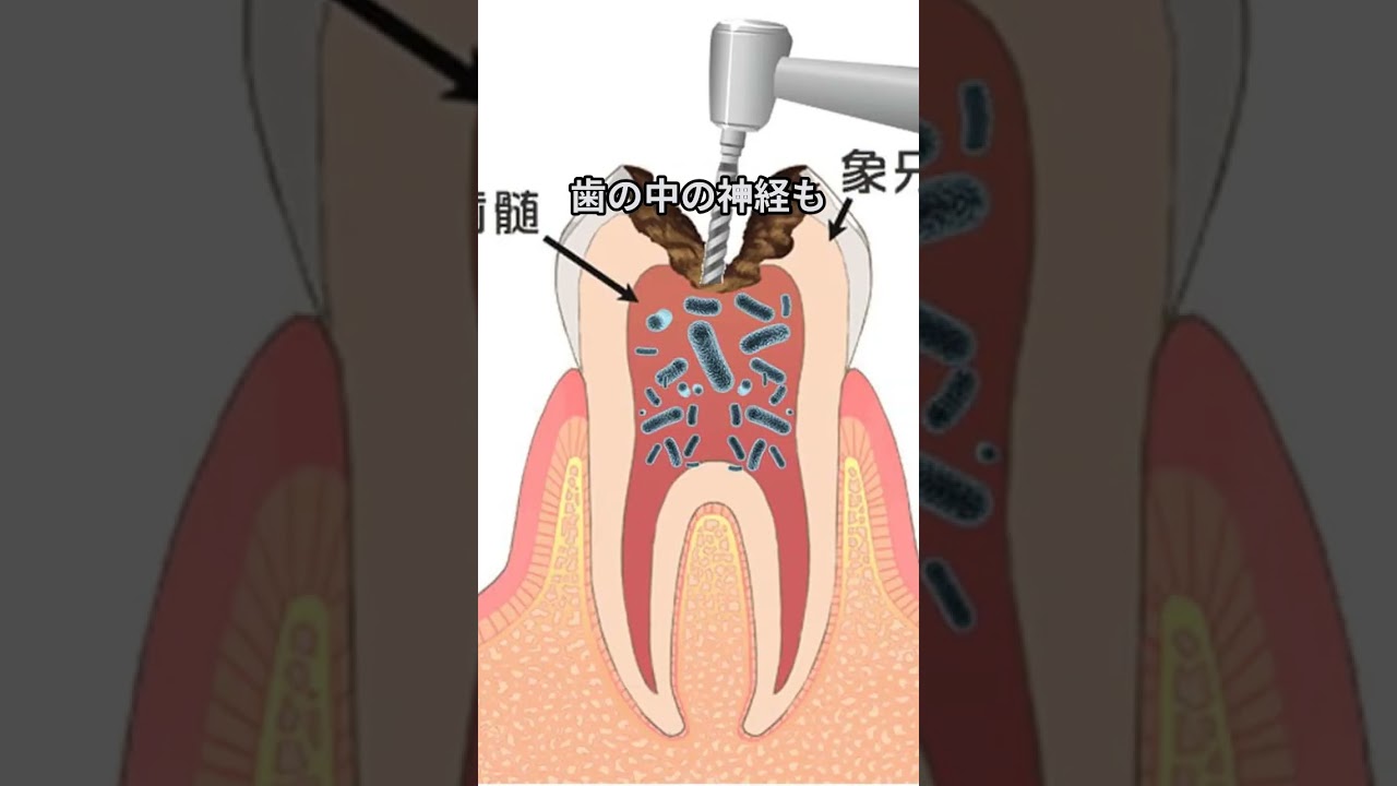 歯の神経を取るってどういうこと？根管治療の全体像 #虫歯 #根管治療 #流れ