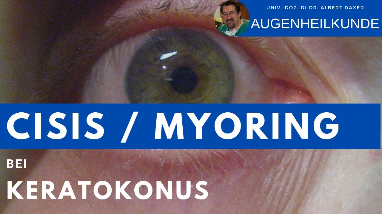 Behandlung des Keratokonus mit CISIS / MyoRing zur Sehverbesserung und zum Stopp des Fortschreitens